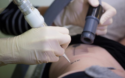 We don't remove your tattoos - you do!